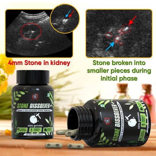 Kidney &amp; Stones