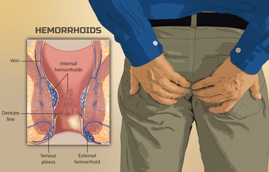 PILES AS PER ALLOPATHIC DOCTORS - The Yoga Man Lab