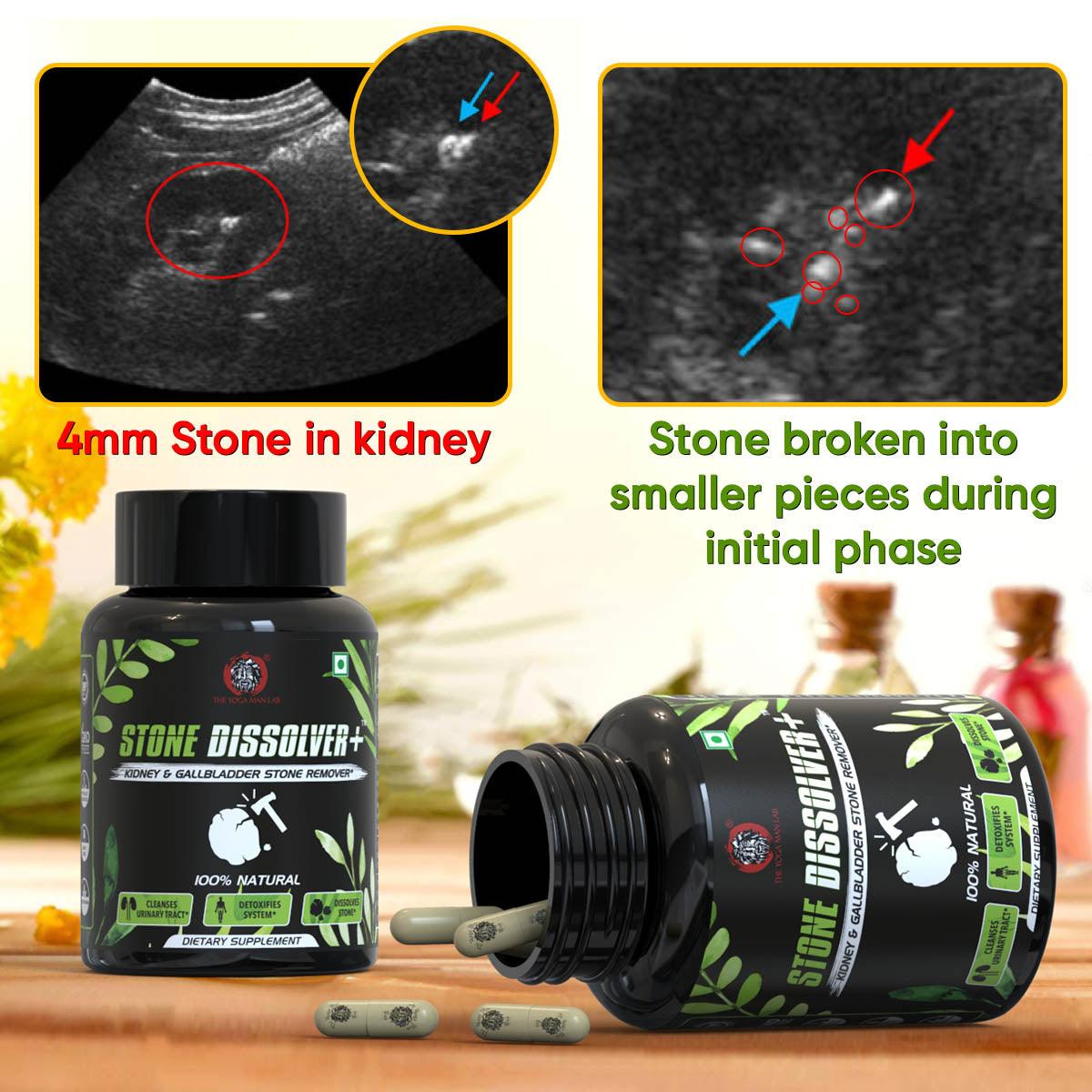 Kidney & Stones - The Yoga Man Lab