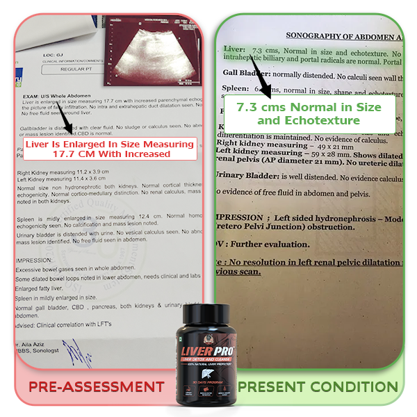Liver Pro -  Ayurvedic Supplement | 28 Days Program To Remove Toxins & Restore Liver Health | 100% Natural