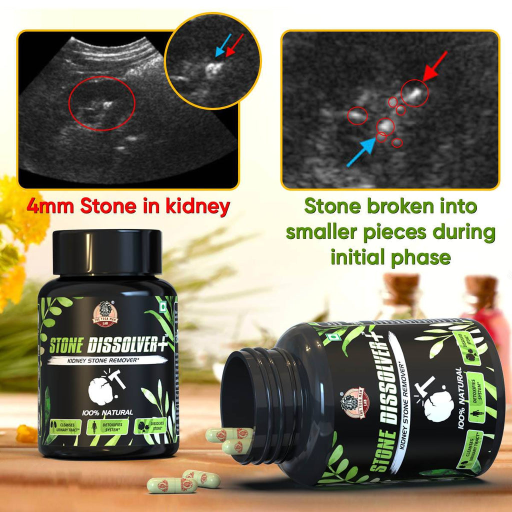 STONE DISSOLVER+ - Stone Remover Ayurvedic Supplement | 100% Natural & Plant Based